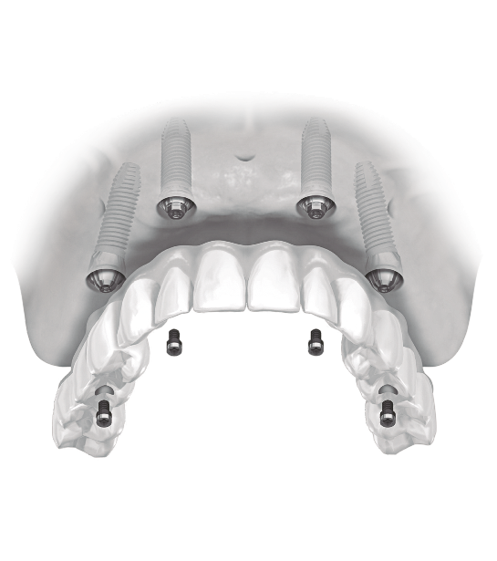 ALL-ON-4 Implantes Dentales